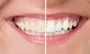 Teeth Bleaching Dental Service South Africa