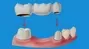 Dental Bridge Service South Africa
