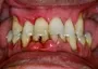 Periodontal Disease Treatment South Africa