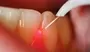 Soft Tissue Laser Dental Services In South Africa